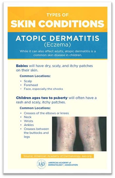 Atopic Dermatitis
