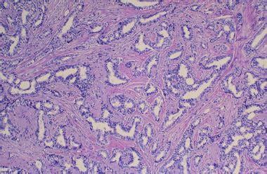 Invasive Ductal Carcinoma Histology