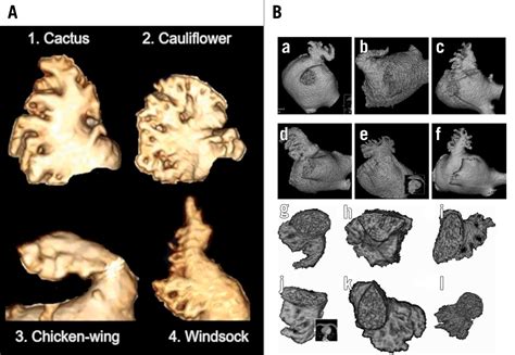 Left atrial appendage occlusion | EuroIntervention