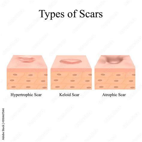 Types of scars. Acne scars. Keloid, hypertrophic, atrophic ...