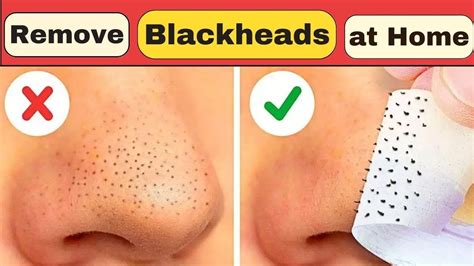 how to remove blackheads on nose naturally at home | black dots on the ...