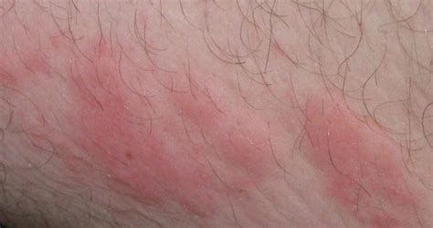 Stress Rash: Causes, Symptoms, and Treatment - YouMeMindBody