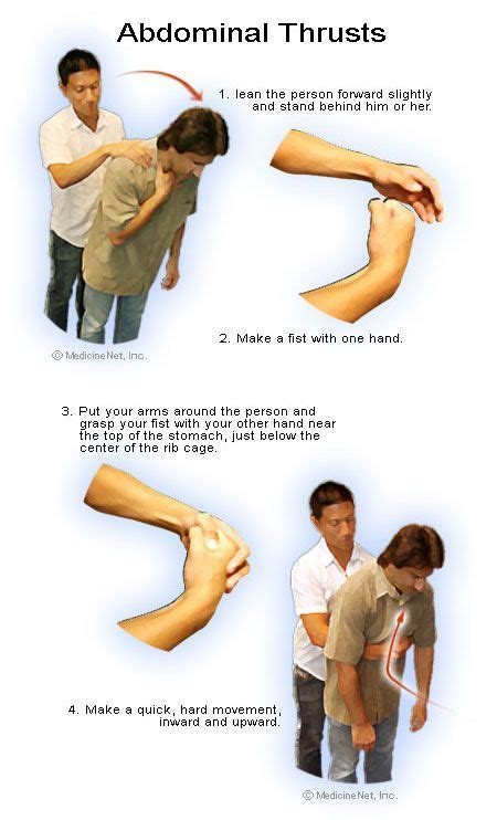 Abdominal Thrusts. This is a first aid procedure used to treat choking caused by foreign objects ...