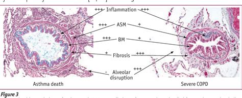 Figure 3 from Mechanisms in COPD compared with asthma Educational aims | Semantic Scholar