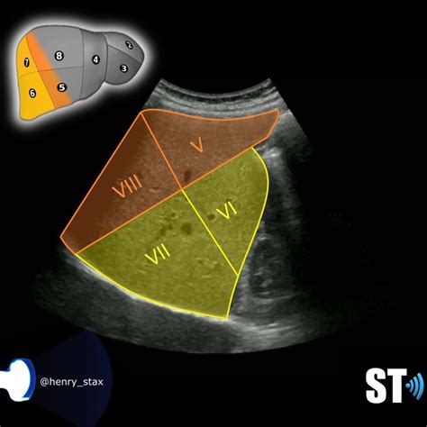 Couinaud’s Liver Segments – Sonographic Tendencies | Segmentation ...