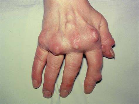 Gout: Signs, Symptoms, and Complications