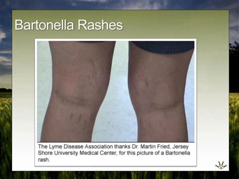 PPT - Symptoms: common and less common Lyme Disease Misdiagnosed as Photos: Lyme Rash Bartonella ...