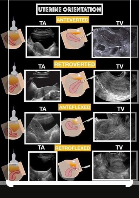 Transvaginal Ultrasound Orientation Pictures To Pin On Pinterest | My XXX Hot Girl