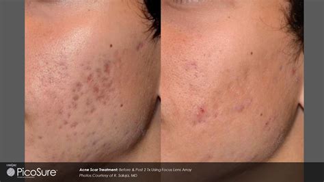 Pico - Acne Scars Removal Blog