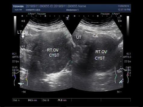 Ultrasound Video showing a large chocolate ovarian Cyst. - YouTube