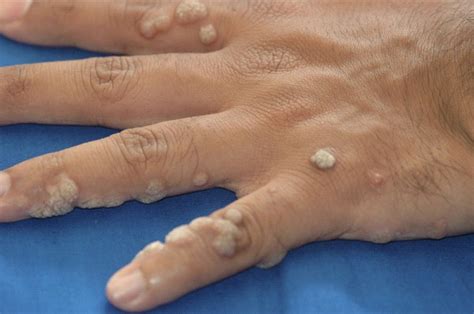 Common Warts Symptoms, Causes, Risk Factors, Diagnosis And Treatment ...