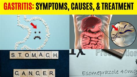 Gastritis: Causes, Symptoms, Diagnosis, & Treatment - YouTube