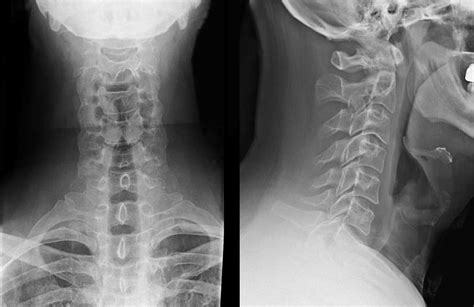 Cervical Spine Radiographs in the Trauma Patient - EP Wellness ...