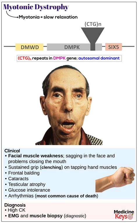 Myotonic dystrophy, type 1 - Medicine Keys for MRCPs