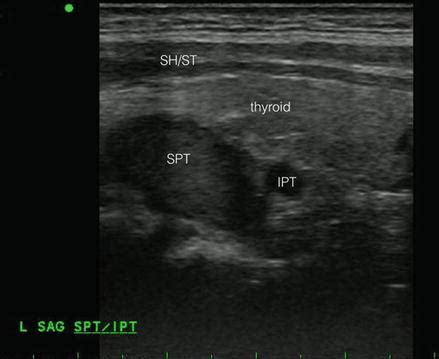 Intraoperative Parathyroid Ultrasound | Ento Key