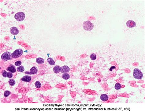 Pathology Outlines - Papillary thyroid carcinoma overview