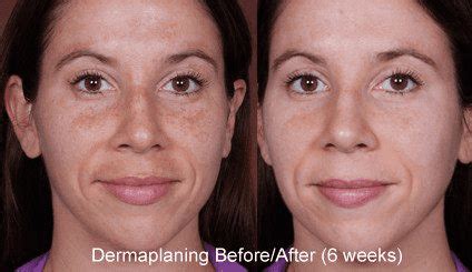 Dermaplanning before and after: Best Guide 2022 - ineedskin