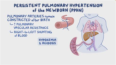 Persistent pulmonary hypertension of the newborn (PPHN): Nursing ...