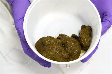 Stool sample for faecal transplantation - Stock Image - C026/7187 - Science Photo Library