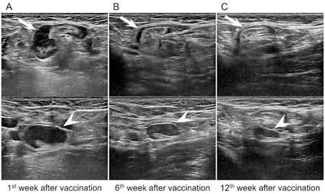 Ultrasound shows persistence of vaccine-related lymphadenopathy