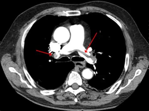 PERC Safely Rules Out Pulmonary Embolism in ED Setting - CRTonline