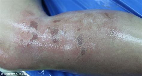 Serious Box Jellyfish Sting in Phuket Region