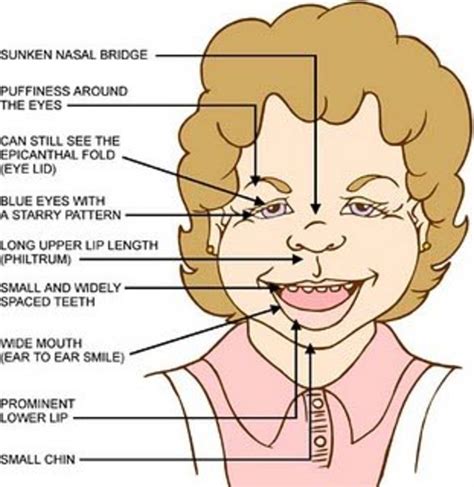 Williams Syndrome -a Genetic Disease of Empathy - HubPages