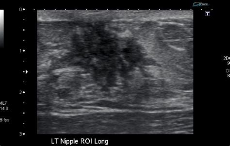 gynaecomastia – ULTRASOUNDPAEDIA