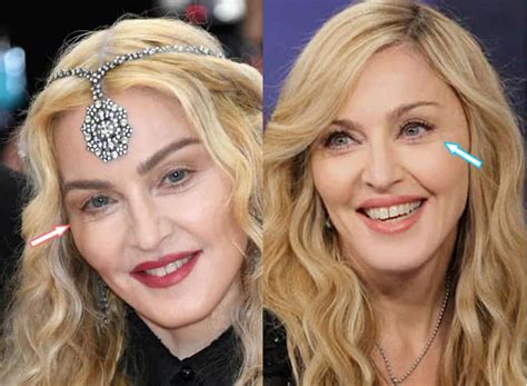 Did Madonna EVER Have Plastic Surgery? (Before & After 2021)