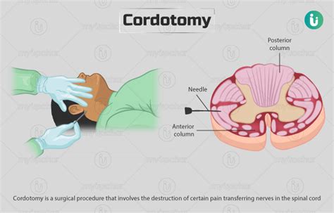 Cordotomy: Procedure, Purpose, Results, Cost, Price, Indications, Recovery