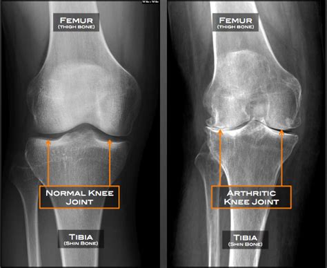 Penawar Sakit Lutut Akibat Osteoartritis - KLINIK DR HASBI