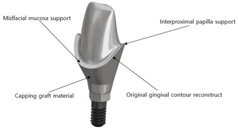 Applied Sciences | Free Full-Text | Soft Tissue Evaluation of an Immediate Esthetic Zone Single ...