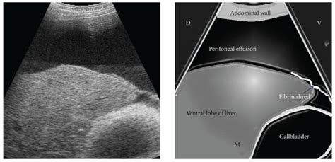 Ultrasonogram of the liver submerged in peritoneal effusion, with ...