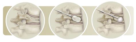 Balloon Kyphoplasty for Vertebral Compression Fracture in Connecticut ...