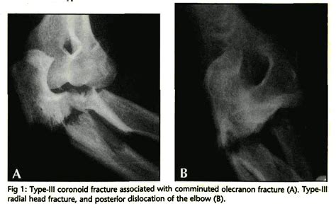 RECONSTRUCTION OF THE CORONOID PROCESS WITH A RADIAL HEAD FRAGMENT