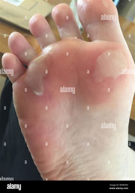 Blister foot hi-res stock photography and images - Alamy