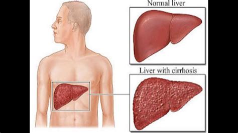 12 WAYS YOUR BODY TRIES TO TELL YOU THAT YOUR LIVER IS BEING DAMAGED! - HealthTimes