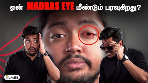 Why Madras Eye is spreading FASTER? | மெட்ராஸ் ஐ | LMES | # ...