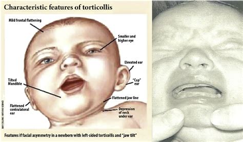 Characteristic features of torticollis. In the picture on the right,... | Download Scientific ...