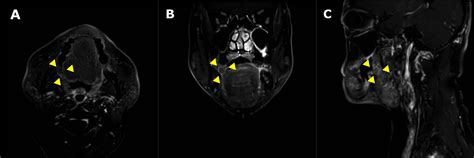 Cureus | Surgery for Cystadenoma of the Retromolar Pad Area With ...