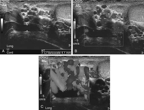 Scrotal Mass and Scrotal Pain | Radiology Key