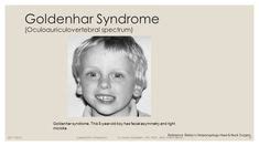 19 Syndrome cause Hearing Loss ideas | hearing loss, syndrome, hearing