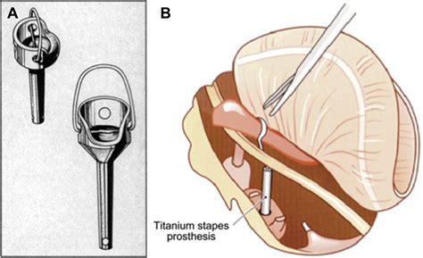 Revision Surgery for Otosclerosis - Otolaryngologic Clinics of North America