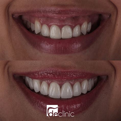 Laminate Veneer - Dental Excellence Turkey | Dental Clinic in Antalya Turkey