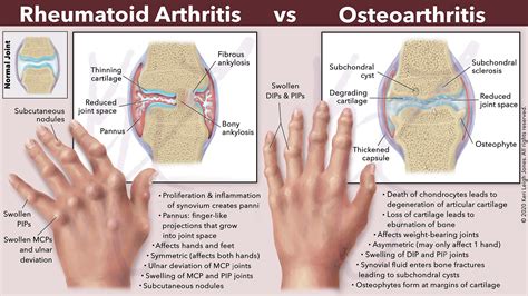 Rheumatoid Arthritis vs Osteoarthritis | Keri Leigh Biomedical Creations