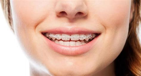 Orthodontics Australia | What Are The Alternatives For Braces?