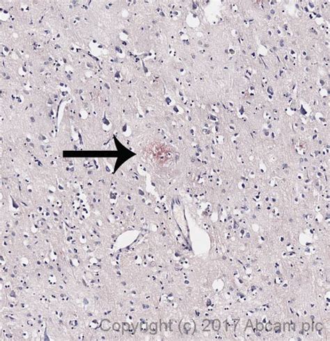 Congo Red Amyloidosis Histology / Renal Histology With Congo Red Staining Revealing Extensive ...