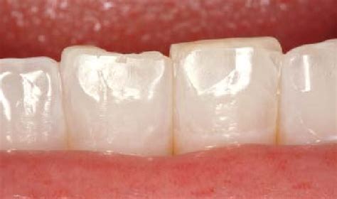 Heavy leading edge wear with limited crossover incisal edge wear. Note... | Download Scientific ...