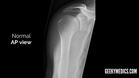 Shoulder X-ray Interpretation | Radiology | Geeky Medics