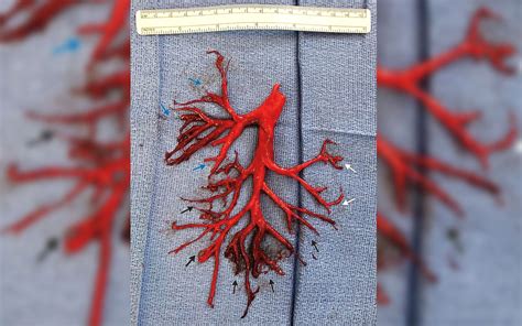 Man Coughs Up a Giant Blood Clot in the Shape of His Lung | Live Science